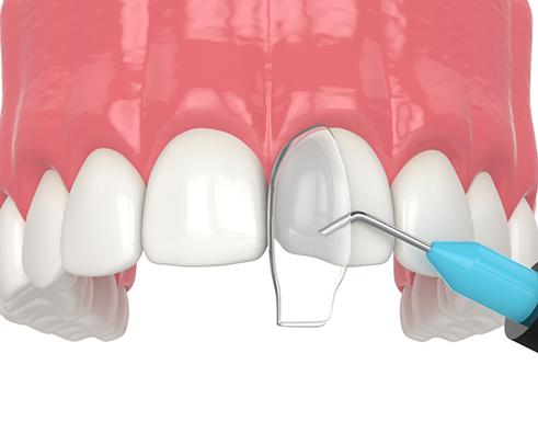 Illustration of cosmetic bonding for upper teeth