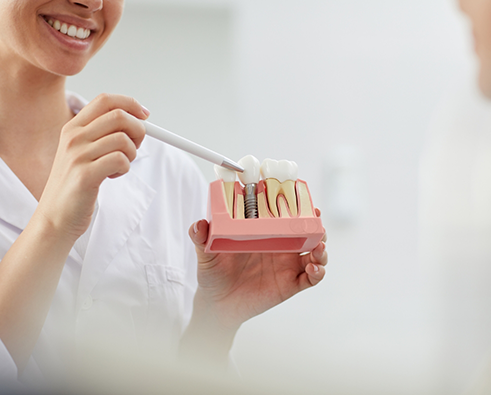 Dentist pointing to a model of a dental implant in Houston