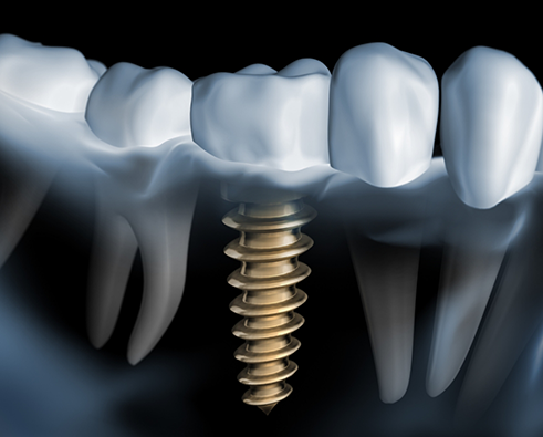 Illustration of dental implant in lower jaw