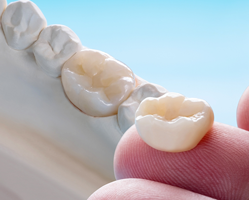 Dental crown in model of mouth and dental crown on finger