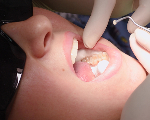 Patient holding mouth open for a tooth colored filling