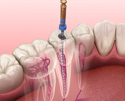 Illustration of root canal treatment in Houston