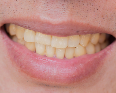 Close up of smile with yellowed teeth